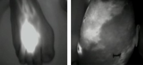 lymphoedema_image_2.jfif