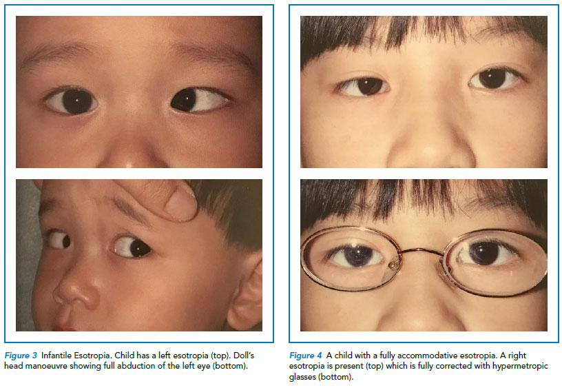 Child with infantile esotropia and child with fully accommodative esotropia - Singapore National Eye Centre