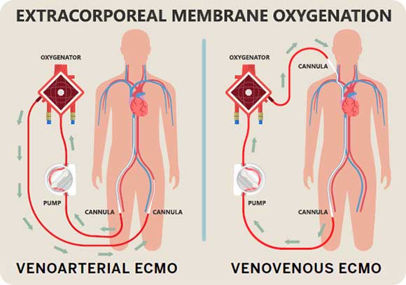 extracorporeal membrane oxygenation (ECMO) for sudden cardiac arrest