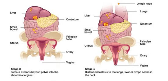 grade of ovarian cancer