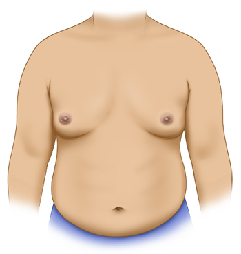 Gynaecomastia Surgery - Male chest before surgery