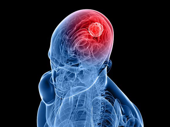 brain cancer conditions & treatments