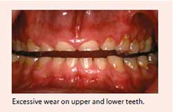 Excessive wear of the hard outer layers (enamel and dentine) - National Dental Centre Singapore