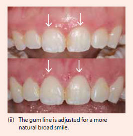 Gum surgery to adjust gum line for more natural broad smile - NDCS