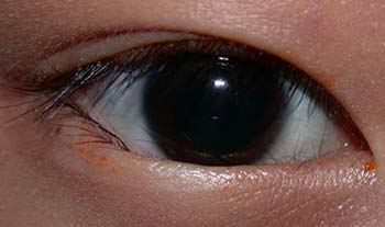 epiblepharon causes eyelashes touching cornea