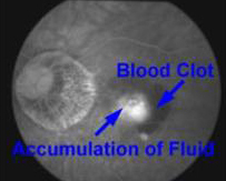 Myopic Maculopathy Blood Clot