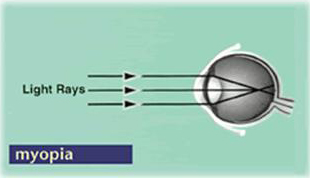 Myopic Maculopathy Myopia