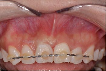 splitting of upper teeth after avulsion