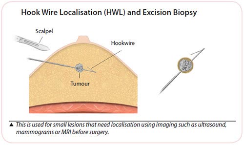 breast cancer diagnosis - hook wire localisation biopsy