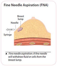 breast cancer fine needle aspiration