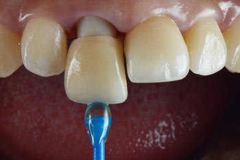 crown cemented onto prepared tooth