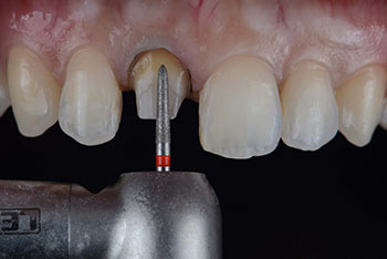 trimming of the tooth for fitting crown