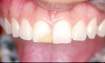 crowns for correcting teeth problems