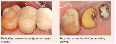 defective-fillings-by-national-dental-centre-singapore
