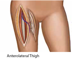 Anterolateral Thigh (ALT) Flap - SingHealth Duke-NUS Head and Neck Centre