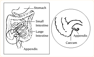 acute appendicitis conditions & treatments