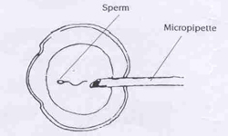 injecting single sperm into an egg