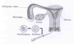 eggs fertilised in-vitro (IVF) with sperms