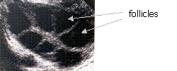 transvaginal ultrasound scan showing follicles in the ovary