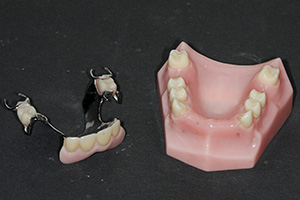 Image of a partial denture