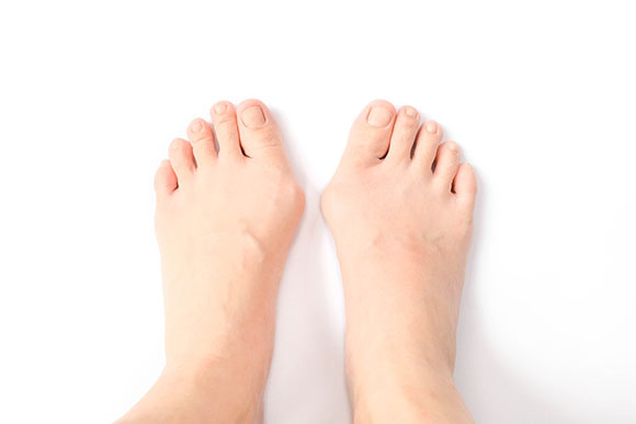 Bunion (Hallux Valgus) conditions and treatments