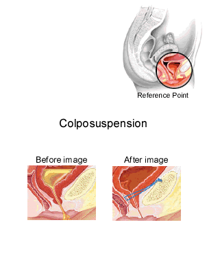 Colposuspension Before After Singapore General Hospital
