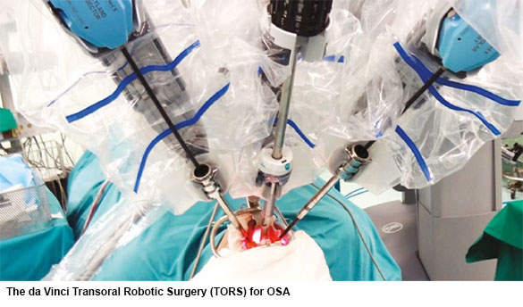 The da Vinci Transoral Robotic Surgery (TORS) for OSA - Obstructive Sleep Apnoea (OSA) Conditions and Treatments