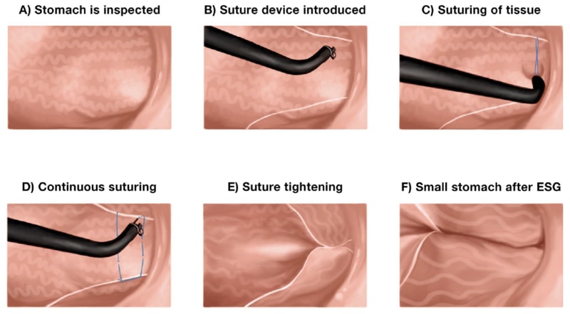 Endoscopic sleeve gastroplasty process - SGH